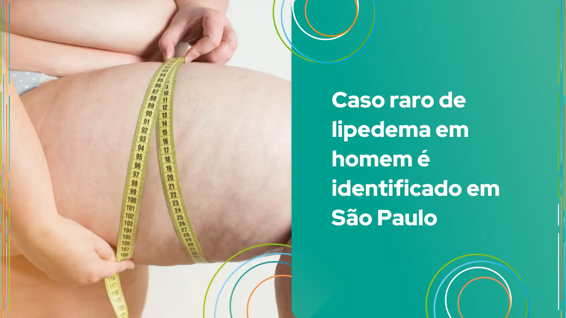 Imagem que ilustra um caso raro de lipedema em homem, com uma pessoa medindo a circunferência da cintura usando uma fita métrica, destacando a condição em São Paulo.