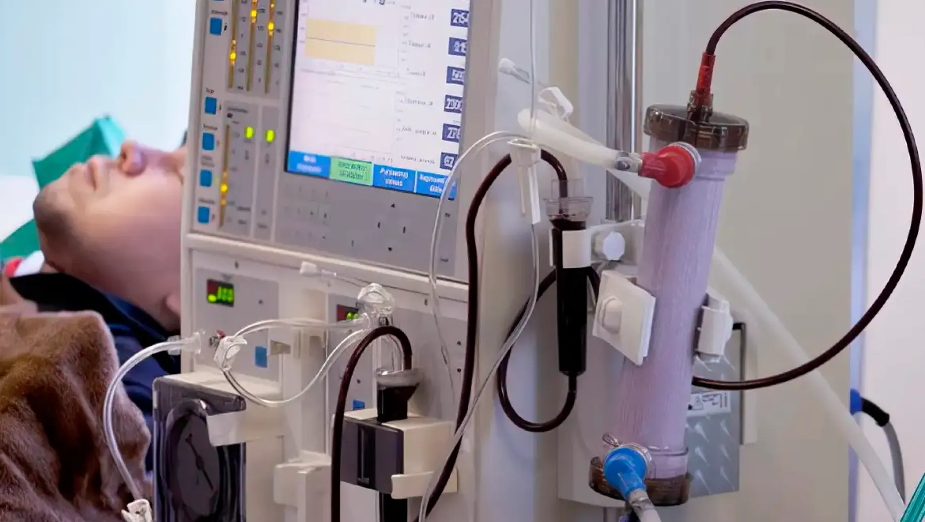 Cenário hospitalar com equipamentos de diálise, tubos e conexões ligados a uma máquina ao lado de um paciente em um leito, ilustrando ambiente de tratamento para doença renal.